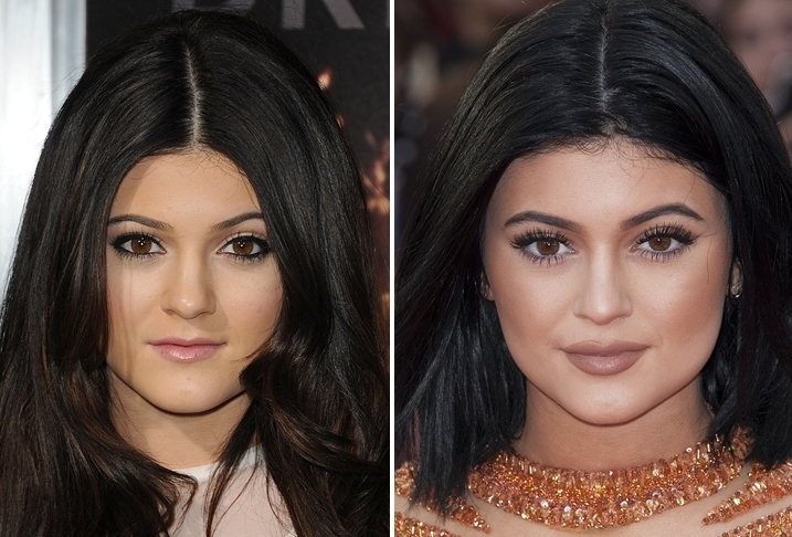 Plasztikai műtéten esett át Kylie Jenner?