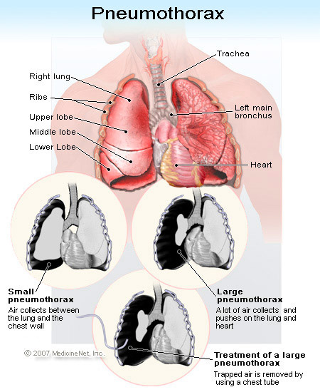Tüdőlebeny betegségei